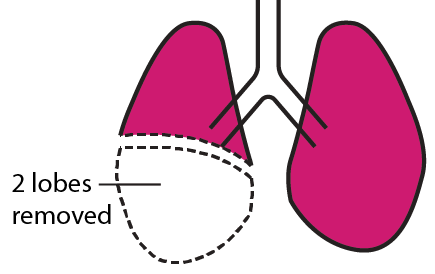 Bilobectomy