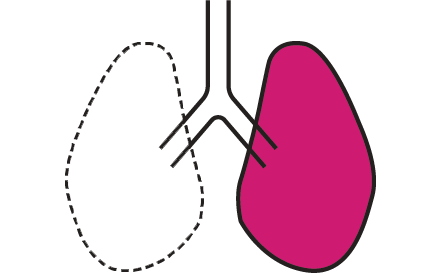 Pneumonectomy