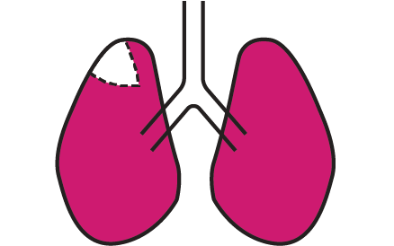 Wedge resection