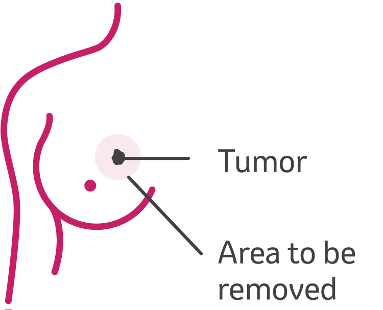 Lumpectomy