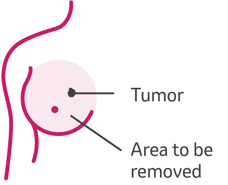 Mastectomy